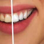 wybielanie zębów - efekty