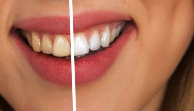 wybielanie zębów - efekty